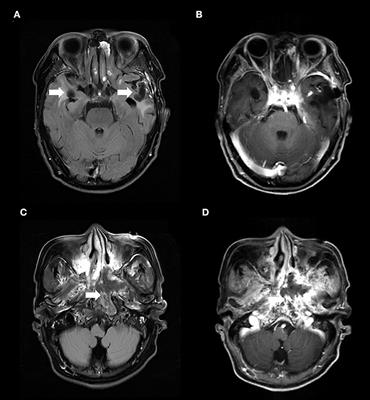 Acute bacterial encephalitis complicated with recurrent nasopharyngeal carcinoma associated with Elizabethkingia miricola infection: A case report